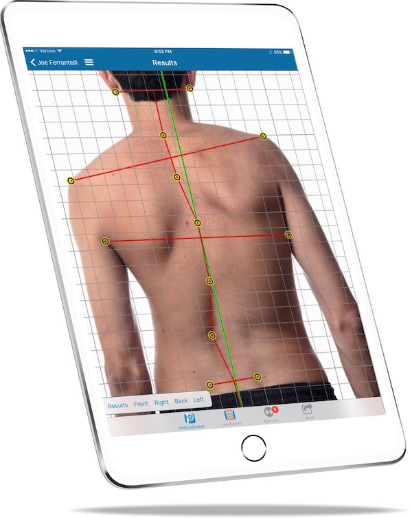 Analyse posturale PostureScreen sur tablette, repères anatomiques mesurés sur la photographie