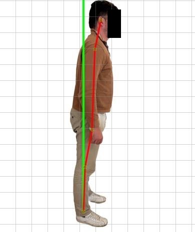 Avant ajustements chiropratiques - Clinique de la colonne